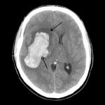 Accidente Cerebrovascular Isquemico Agudo