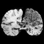 Malformaciones O Fistulas Arteriovenosas Cerebrales