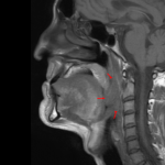 Tumores De Cabeza Y Cuello